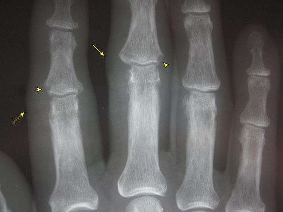 EIA: Radiographs hands wrist and feet Baseline for monitoring disease progression Joint erosion?