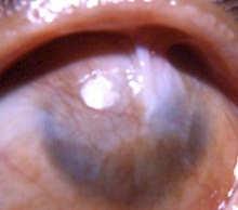 Stem Cell Treatment for Eye Diseases Professor