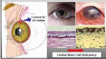 NSFC/RGC Funding ipsc Project Generation of corneal epithelial stem cells from human induced pluripotent stem cells (ipsc) and application for corneal epithelial tissue engineering Epithelial