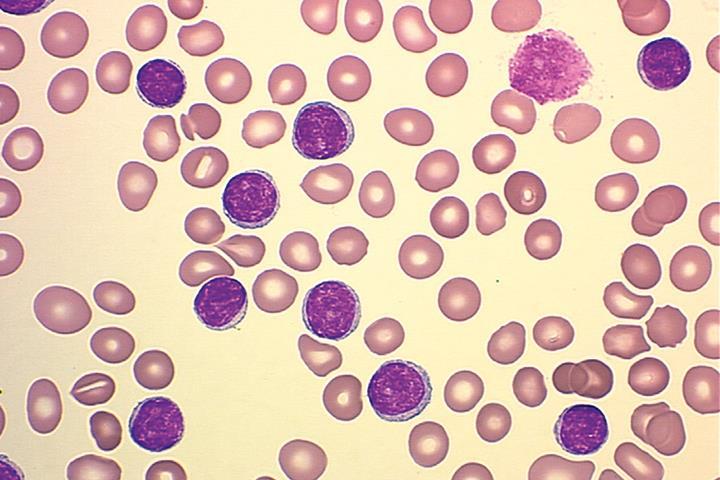 Chronic Lymphocytic Leukaemias o Diagnosis: Full blood count Peripheral blood smear Reticulocyte count and a direct Coombs test Immunophenotyping Serum immunoglobulin levels Bone marrow examination