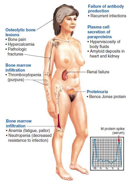 o Clinical features: The main sites involved are: Bones Bone marrow Multiple Myeloma Signs and symptoms are shown in the image Grossman, S, Porth, CM 2013,