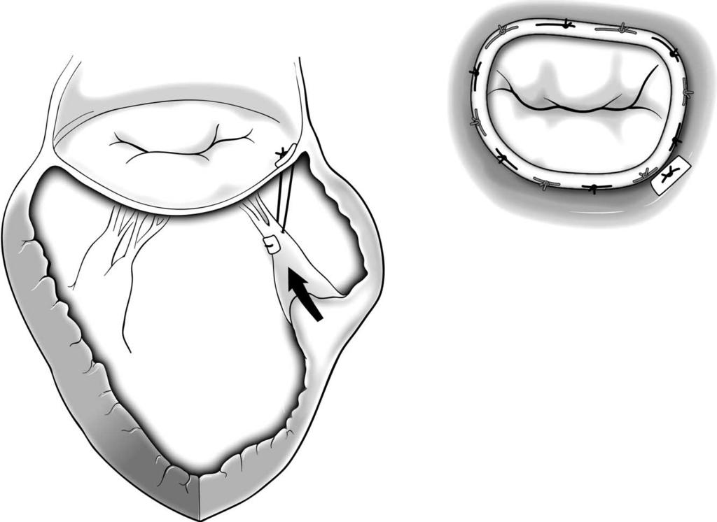 Ischemic mitral regurgitation 117 Figure 5 Posterior papillary muscle relocation.