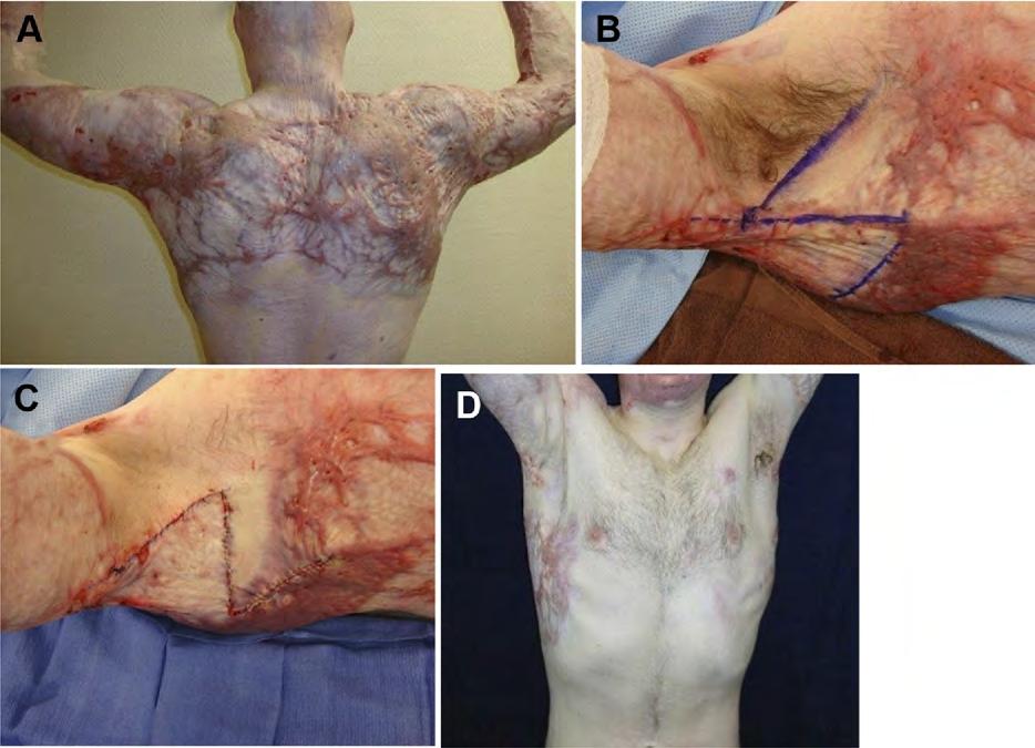 110 Mellus & Chan Fig. 2. Example of Z-plasty releases of bilateral axillary contractures. A 30-year-old man with truncal back and axillary burn scar contractures.