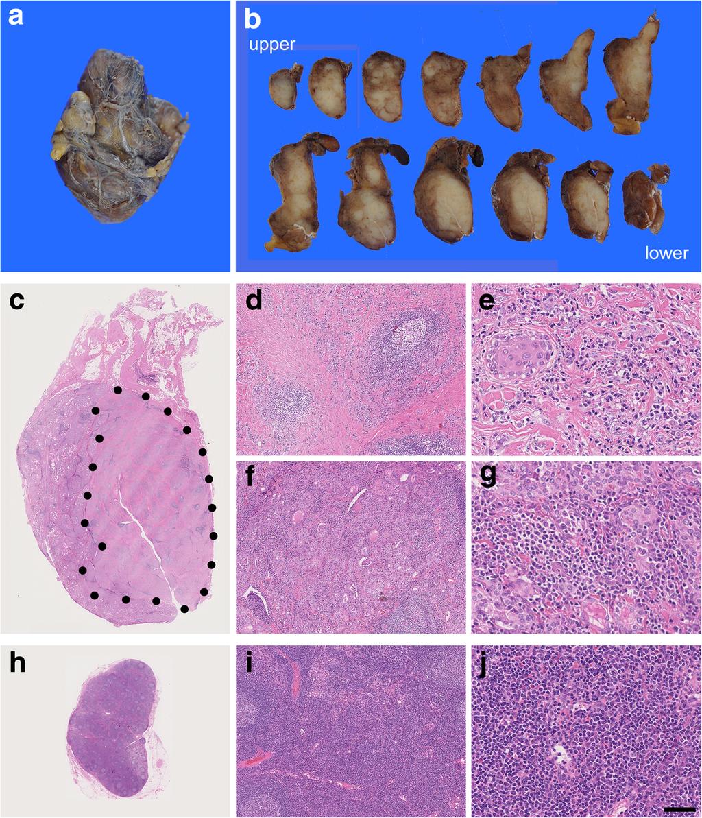Sakai and Imamura Diagnostic Pathology (2018) 13:3 Page 3 of 5 Fig. 1 Gross and histological findings. a, b A circumscribed whitish mass measuring approximately 2.