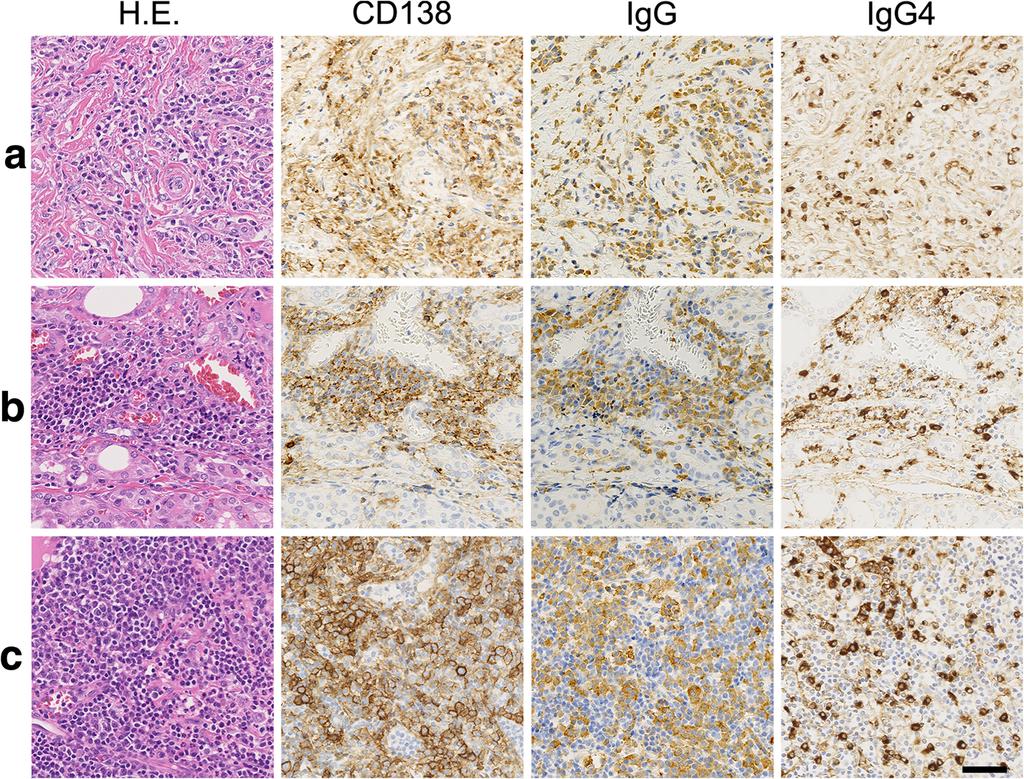Sakai and Imamura Diagnostic Pathology (2018) 13:3 Page 4 of 5 Fig. 2 Immunohistochemical findings of (a) lower pole s mass, (b) background tissue in the thyroid, and (c) the regional lymph node.