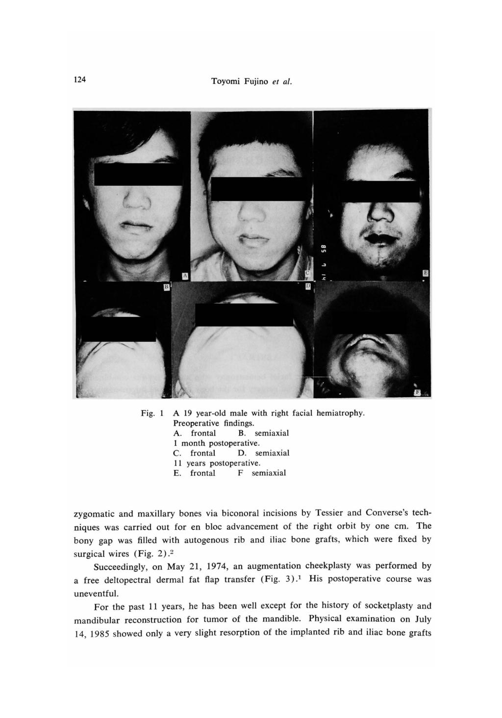 124 Toyomi Fujino et al. Fig. 1 A 19 year-old male with right facial hemiatrophy. Preoperative findings. A. frontal B. semiaxial 1 month postoperative. C. frontal D. semiaxial 11 years postoperative.