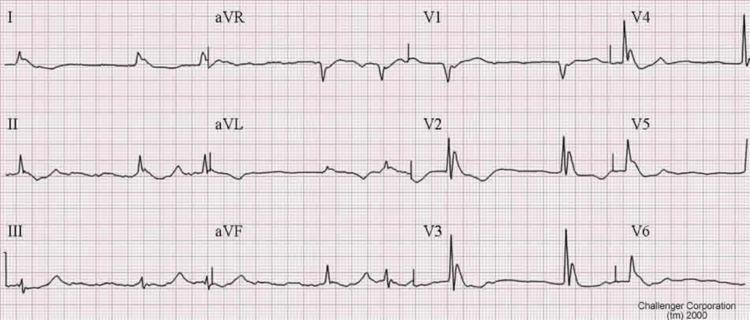 Arrhythmia Complications EKG Changes Normal HR at 32 C is 40 beats per minute Prolonged PR interval, widening of the QRS complex, increased QT interval, Osborn waves