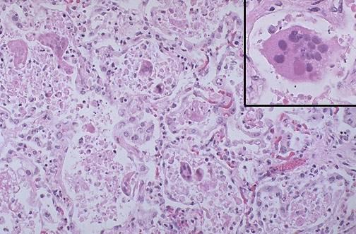 Multinucleated giant cell formation in RSV pneumonia Epidemiology Ubiquitous Virtually all children infected by age 2 Severe illness most