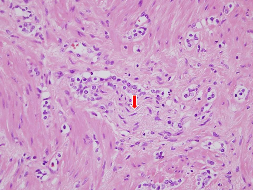 Perineural Invasion in Prostate Cancer neural invasion, pelvic lymph-node metastasis at radical prostatectomy, and nadir PSA.