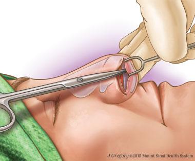 Kadakia, Ovchinsky 571 Fig. 1 Preoperative illustration of the patient prior to making incisions. (Illustration by J. K. Gregory, 2015 Mount Sinai Health System.) or both.