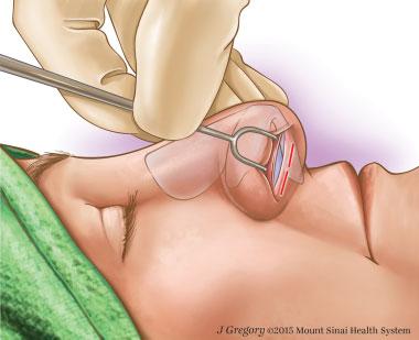 side to secure both medial crura to the caudal septum while tying the knot on the ipsilateral side ( Fig. 4).