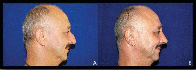 When initially used in closed rhinoplasty approach, TIG technique commonly used an absorbable suture, such as PDS or chromic, to secure the columella to the caudal septal cartilage.