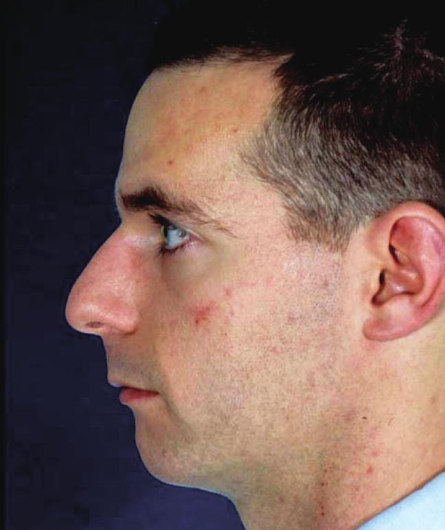 58 Clinical and Experimental Otorhinolaryngology Vol. 4, No. 2: 55-66, June 2011 ows that are expected in the aesthetic nose. Unnatural contours can draw attention to the nose and become distracting.