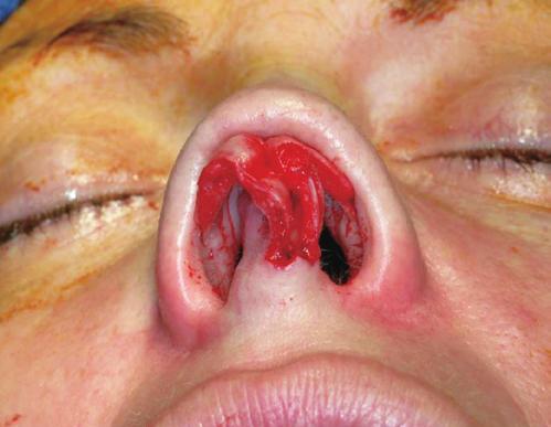hump Under or over projection Alar notching Ptotic tip Saddle nose Pollybeak Tension nose Boxy tip Bulbous tip Bifid tip Amorphous tip Caudal septal deviations genic nasal obstruction.