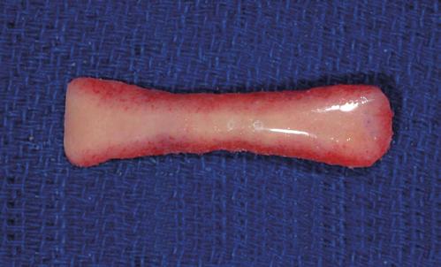 The heavy ingrowth of surrounding tissue can make future removal of the graft challenging.
