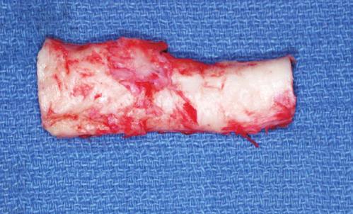 A drawback of this polymer s use is that it seems to be prone to infection, and proper implantation requires meticulous handling during implantation and generous perioperative antibiotics.