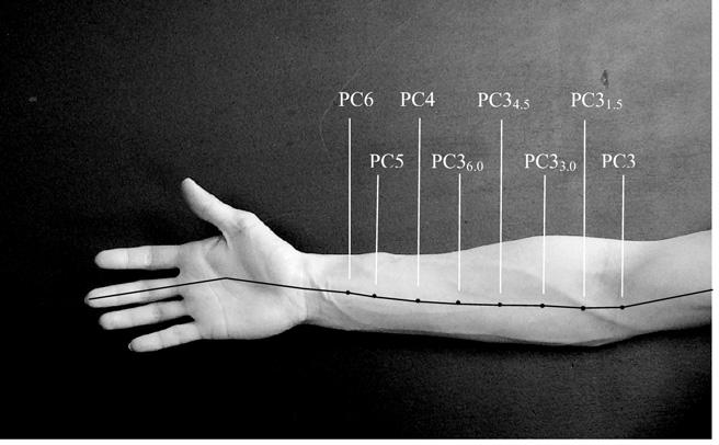SHAM ACUPUNCTURE DISCRIMINATION, Tan 2143 Fig 2. The PC meridian acupoints on the forearm. The figure shows 4 traditional acupoints (PC3, PC4, PC5, PC6) and 4 nontraditional acupoints (PC3 1.5, PC3 3.