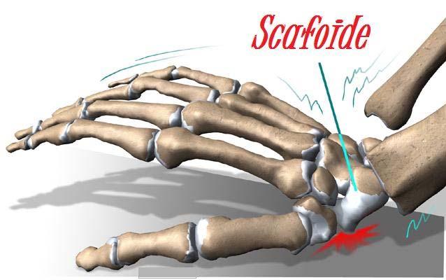 Clinical presentation Ulnar-sided wrist pain