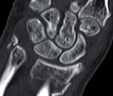 Surgery Treatment of the associated ulnar sided lesions T. Westphal et al.