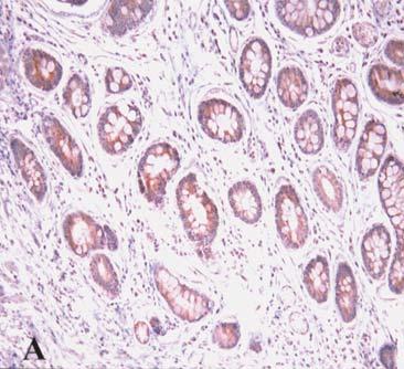 ONCOLOGY REPORTS 17: 1051-1055, 2007 1053 Figure 1. Immunohistochemical staining of sonic hedgehog (Shh) in intestinal metaplasia.