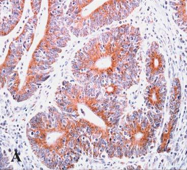 Shh staining revealed strong expression (immunohistochemical staining x200). Figure 2.