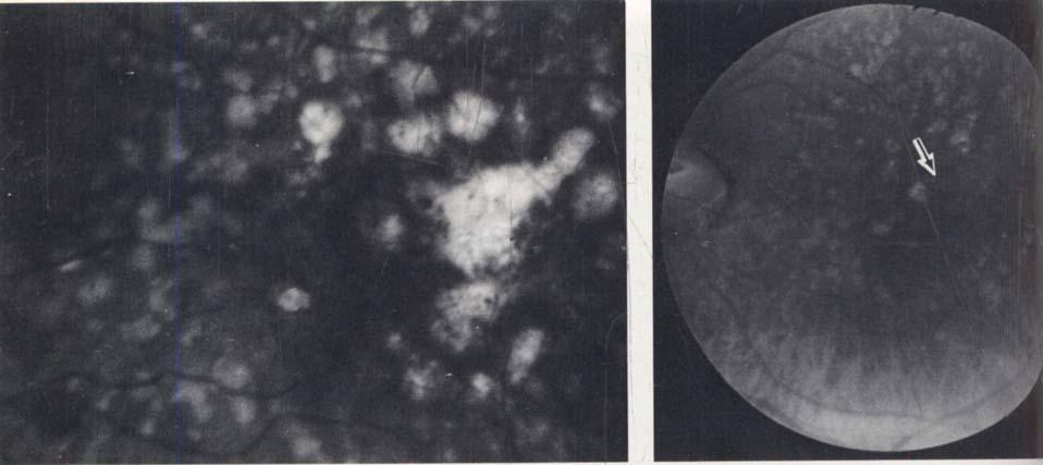 i Figwe 19: Left fundus of patient whose right eye appears in Figure 20: Same eye shown in figure 19, h figure 16. showing the same background of serous drusen.