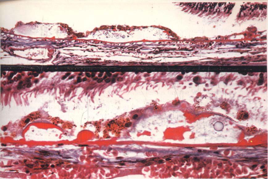 Figure 22: Serogranular drusen from another eye with geographic atrophy and calcifying drusen.