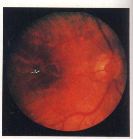 Picro-Mallory stain. X 500. f t, y t t w 5: Fundus of 73-year-old man. vision 6/6 part.