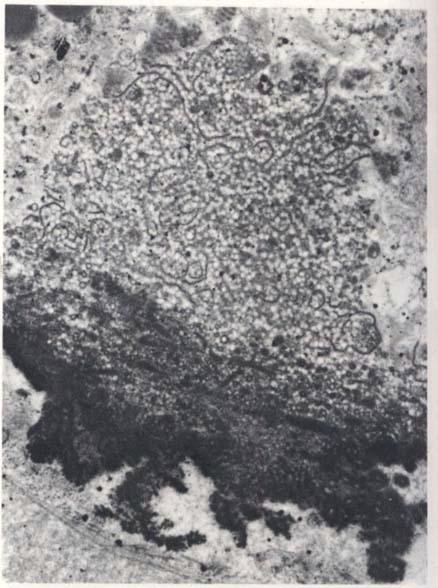 F i p r e 7: Electron micrograph of the right eye of a 68-year-old man whose fundi had shown small drusen similar to those in figure 5. Vision had been 6/6 in both eyes. The left eye.