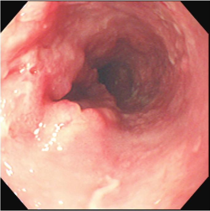 282 The Korean Journal of Internal Medicine Vol. 27, No. 3, September 2012 A b c Figure 1. (A) Before photodynamic therapy (PDT). Endoscopy shows an ulcerofungating mass on the mid-esophagus.