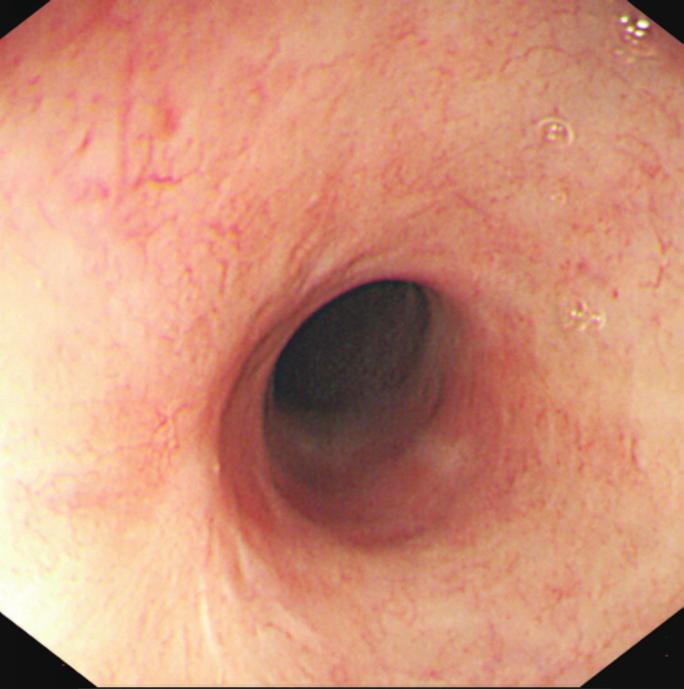 Esophageal strictures following PDT were treated by placement of a modified expandable stent across the stricture. This was fixed to the esophageal mucosa by hemoclips at the upper end.