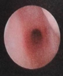 Pierre- Robin Syndrome Figure 10: Laryngomalacia.