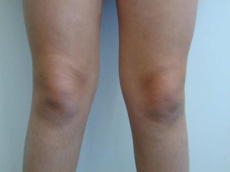 KNEE acute KNEE chronic history: mechanism significant?