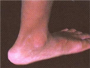 FOOT arch not abnormal FOOT flat foot arch/heel 90%