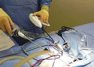 abdominal surgery is a raised intraabdominal pressure (IAP).