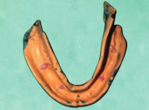 The trial denture was processed, finished and polished (Fig. 9). Space for magnets was made in the maxillary denture.