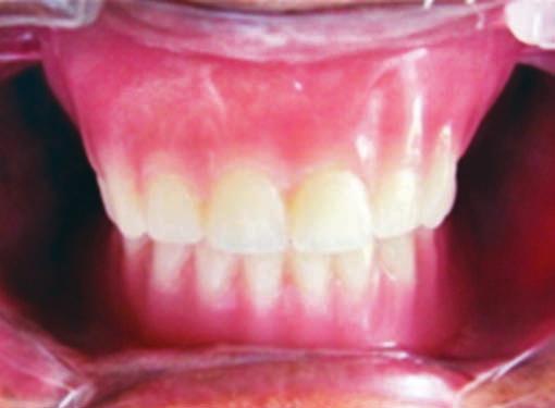 Also in the crucial step of border molding where a precise control of the surrounding tissues is needed, TENS technique may be an alternative approach. REFERENCES Fig. 9: Finished denture Fig.