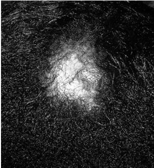 follicle openings Polytrichia Lupus Alopecia Most common scarring alopecia Usually affects