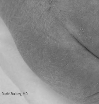 Vellus hairs are smaller in length and diameter and have less pigment Intermediate hairs have mixed characteristics Hair Classification Alopecia Definition Partial or complete loss of hair from where