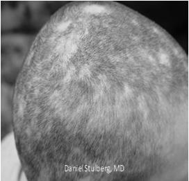 Stamford, Conn: Appleton & Lange; 1996: Can be total, diffuse, patchy, or localized Neoplastic Nevoid Classification of Alopecia Scarring Injury such as burns Cicatricial Inflammatory Systemic