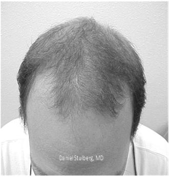 Sparing of occipital and lower parietal fringe of hair Androgenic Alopecia