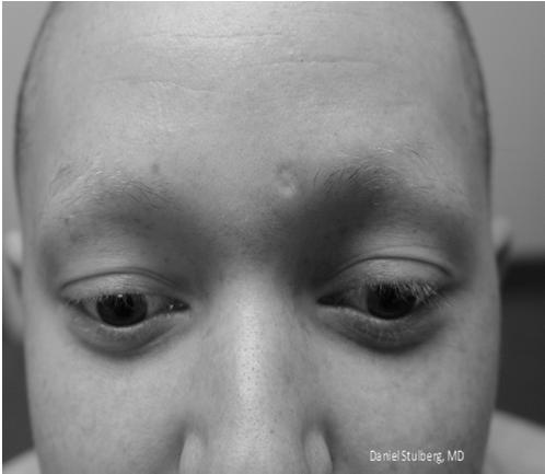 Eyelashes Alopecia Areata Focal