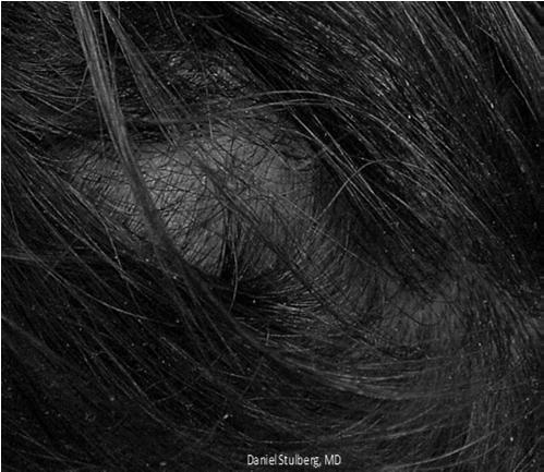 Alopecia Areata Treatment Adjuncts Systemic steroids for larger areas May lose hair when tapered or D/C Minoxidil 5% topically BID w/without steroids but success is varied and is slow 8-45% success