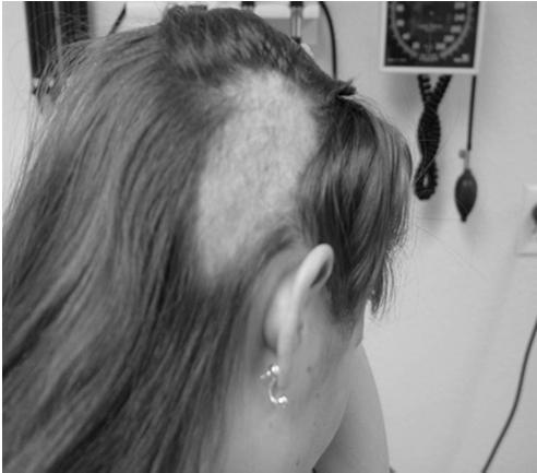 2-3% of all people with hair loss Strange pattern