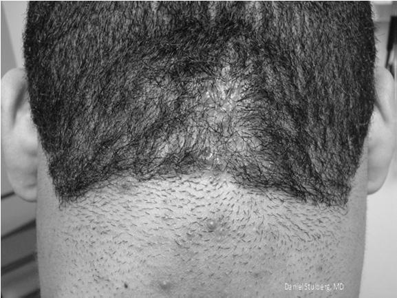 Neurosci Biobehav Rev 2015 Aug;55:294-321 Traction Alopecia Unintentional traumatic hair loss Often seen in athletes and African-Americans when hair is placed in tight