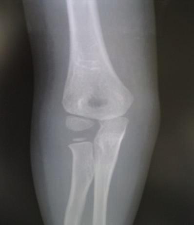 There was severe synovial proliferation in the joint. a diagnosis of septic arthritis of the right elbow was made and the patient was admitted for treatment.