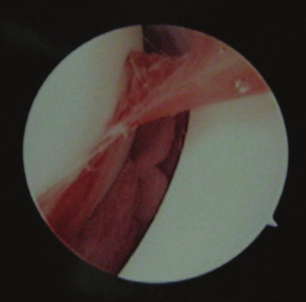 The medial portal was established using the outside-in technique under visual guidance.