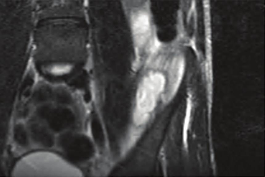 Case Reports in Orthopedics 3 Figure 3: MRI image of iliacus abscess. admission. The iliacus drain was removed 6 days after insertion.