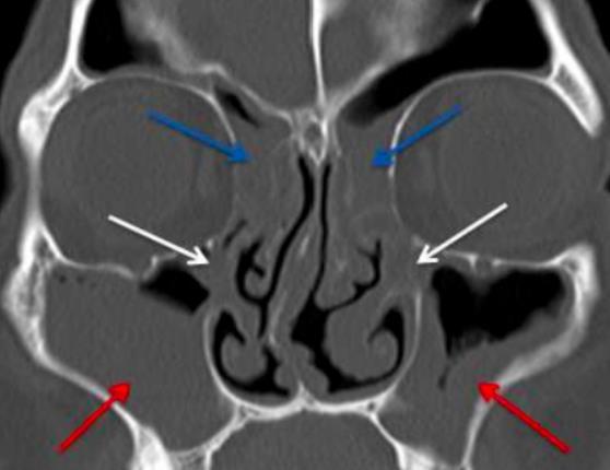 discharge mucosal oedema CT changes mucosal