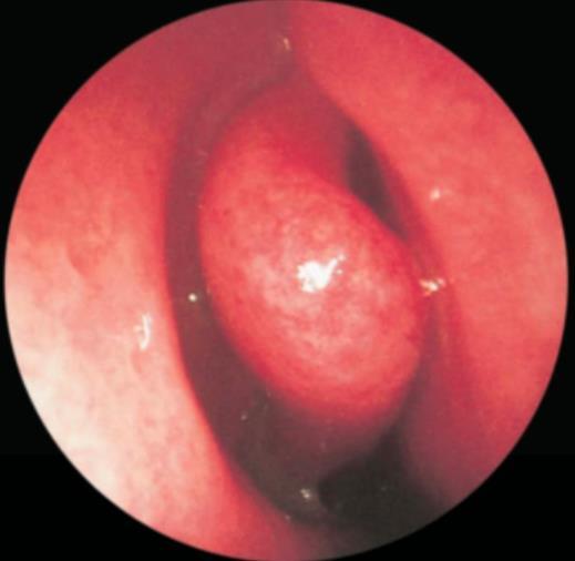 DIAGNOSIS AND at least one of the following: Endoscopic signs of : nasal polyps mucopurulent discharge